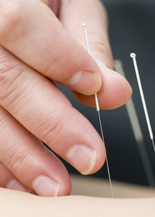 Doctor uses needles for treatment of the patient. acupuncture needles. alternative healthcare